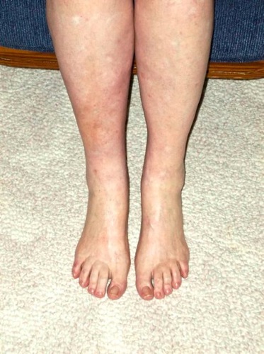 Ema McKinley Healed Legs